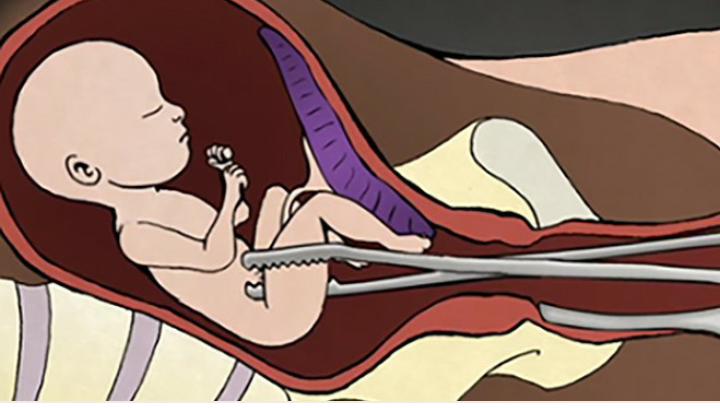 नेपालमा असुरक्षित गर्भपतन गराउने बढ्दै