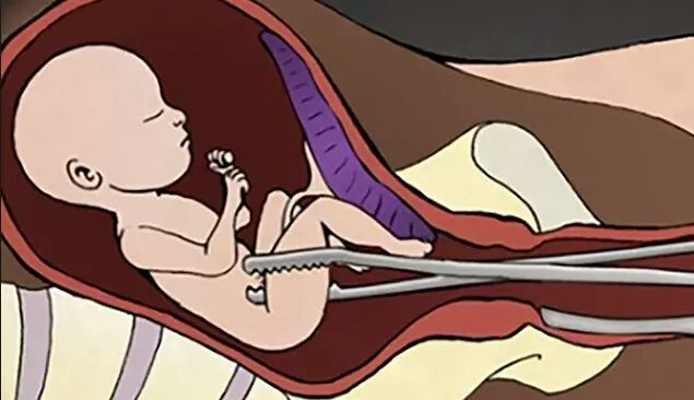 गर्भपतन गराउने बढ्दै...